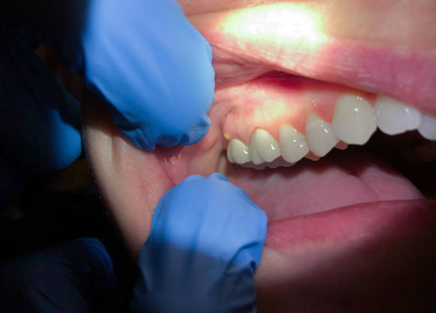 Best Emergency Dentist for Lost Fillings or Crowns in Soh Salt Lake, UT